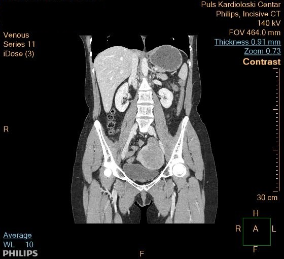 Abdominal and pelvic CT scan