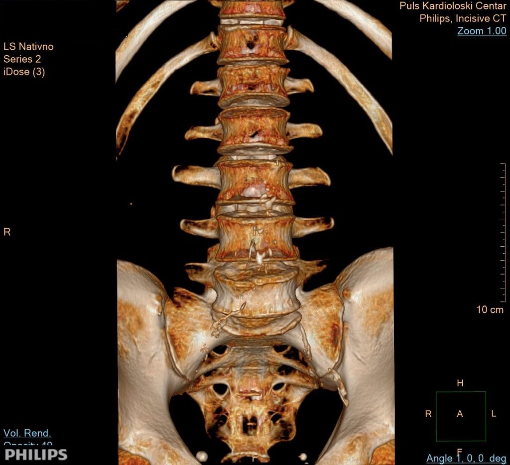 CT skener kičmenog stuba