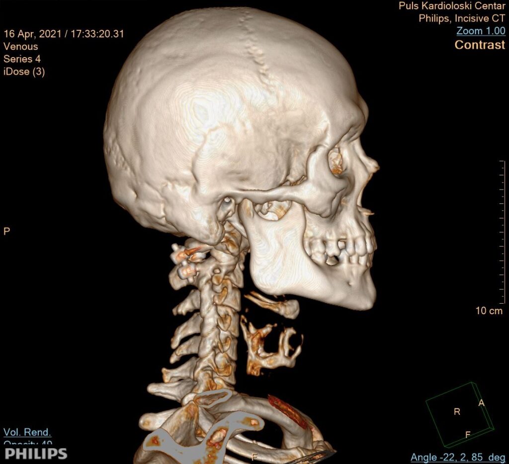 CT skener vratne kičme