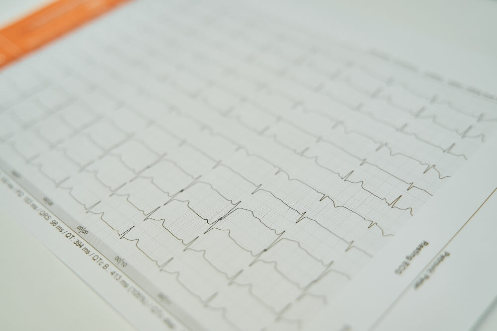 Graphic display of electrocardiography results