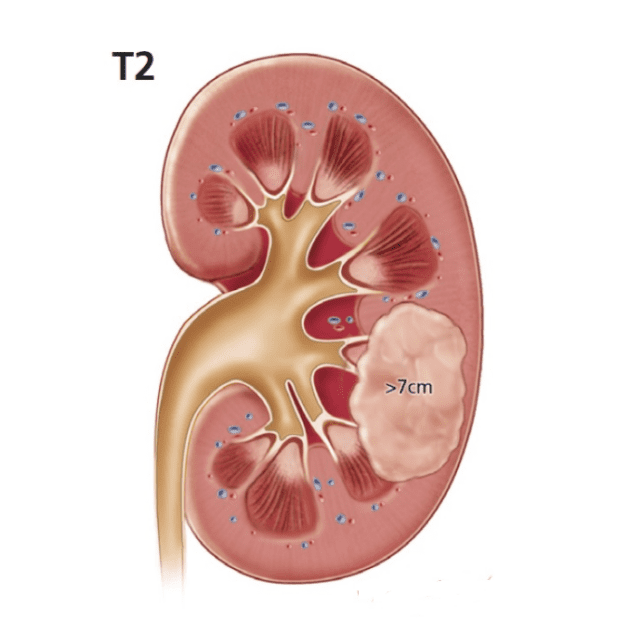 Embolization of kidney tumors | Pulse Cardiology Center