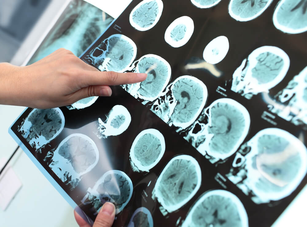 Doktor proučava snimak glave pacijenta koji je doživeo moždani udar