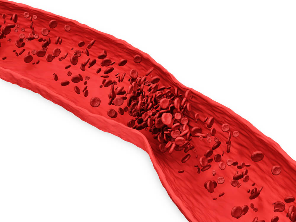 Presentation of thrombus formation