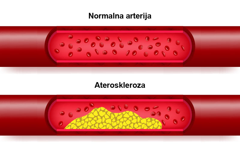 Poređenje normalne arterije sa aterosklerozom