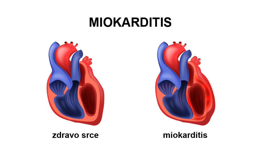 Prikaz zdravog srca i miokarditisa