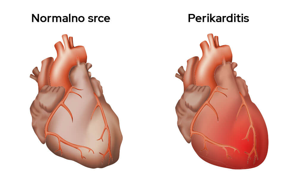 Prikaz normalnog srca i perikarditis