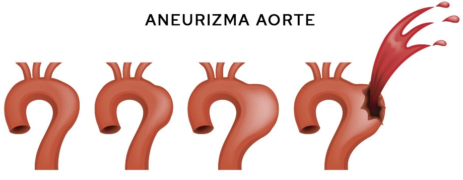 Grafički prikaz aneurizme aorte