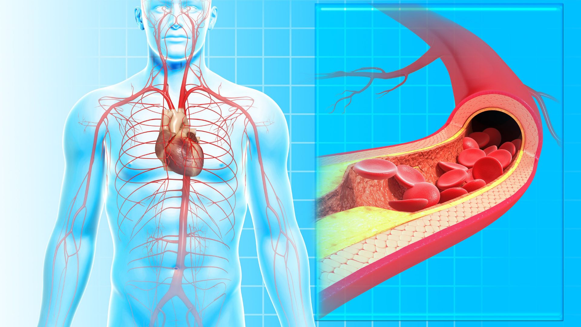 Cardiac Ischemia 